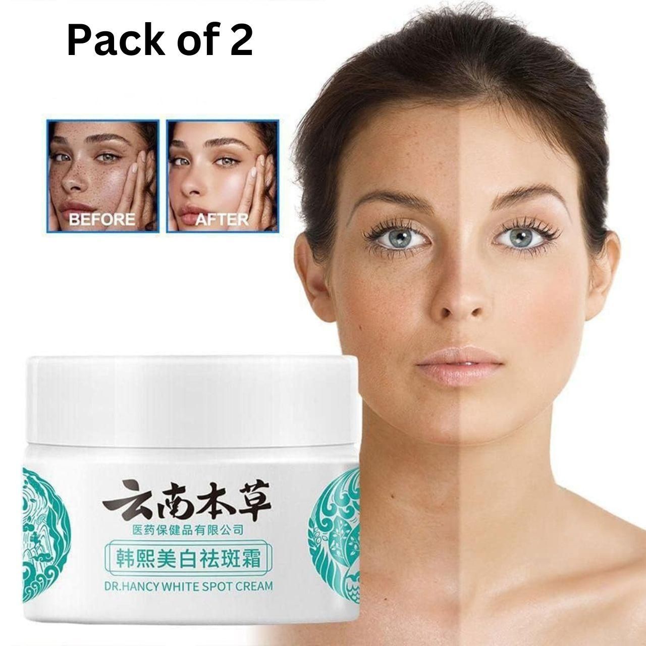 HOT JAPANESE Melasma Cream | White Spots Removal Cream | Skin Care Face Moisturizer Whitening Cream (Pack of 2)