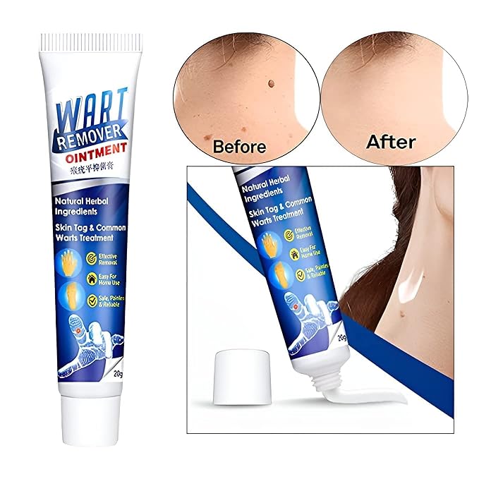 Warts Off Instant Blemish Removal Cream 20g | Wart Remover Ointment for All Skin Types (Pack of 1)